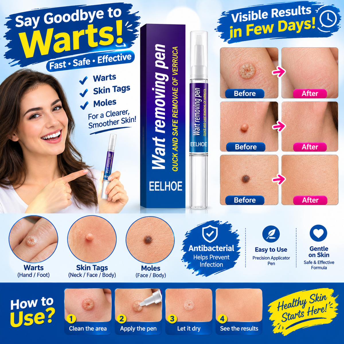 Wart Remover Gel Pen – Targeted Wart Treatment for Hands & Feet