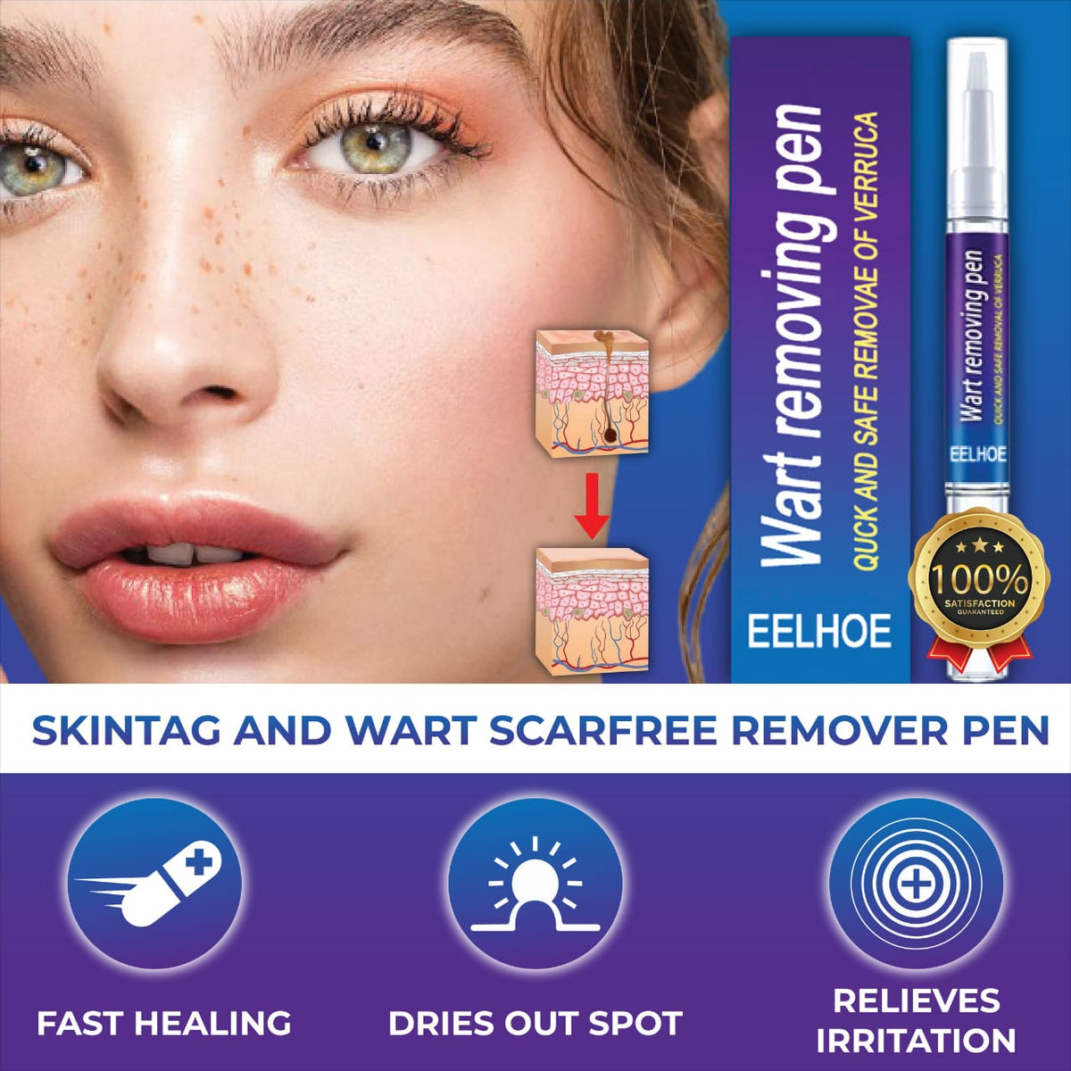 Wart Remover Gel Pen – Targeted Wart Treatment for Hands & Feet