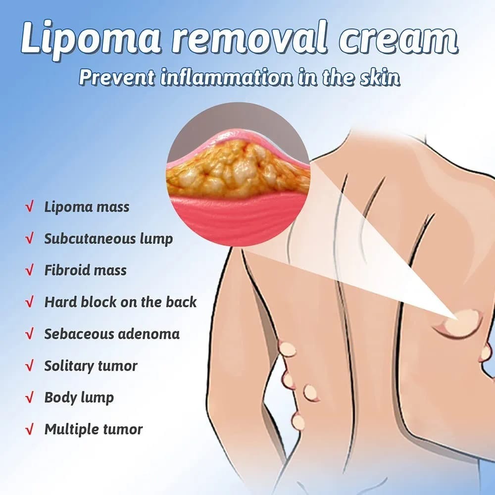 South Moon Lipoma Removal And Body Smoothing Cream